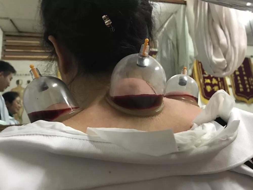 刺血培訓選擇好的學校真的那么難嗎？