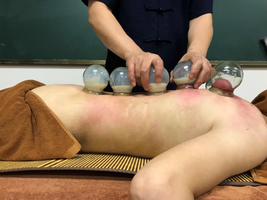 中醫(yī)可以通過(guò)拔罐辨別體質(zhì)